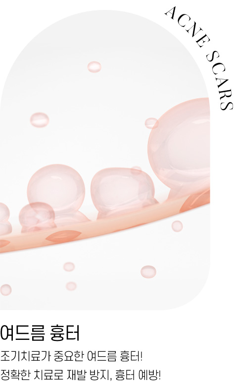 여드름 흉터 : 조기치료가 중요한 여드름 흉터! 정확한 치료로 재발 방지, 흉터 예방!