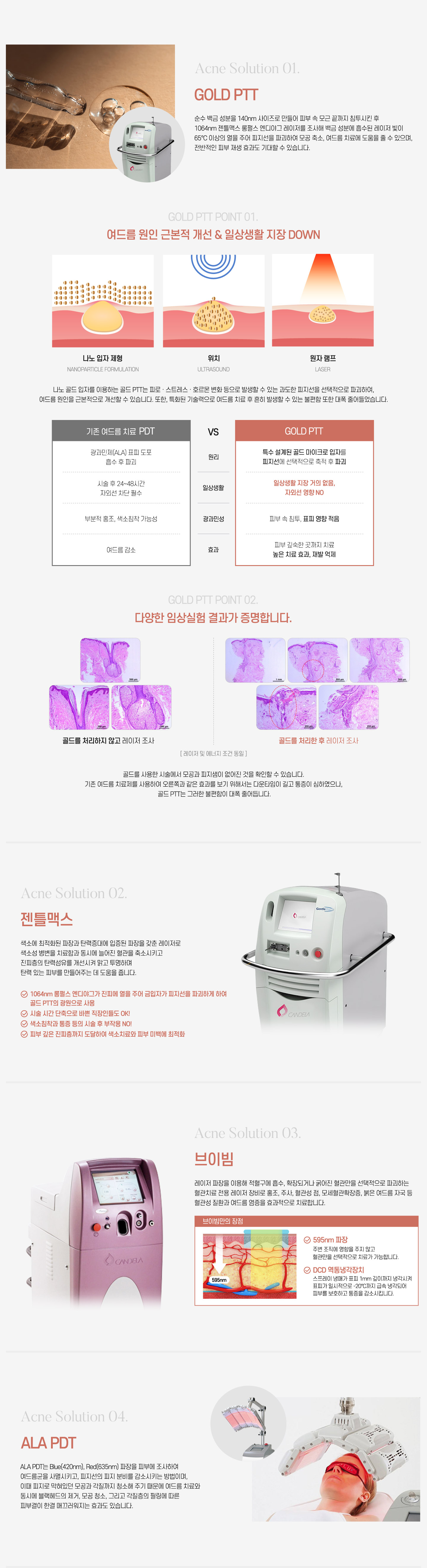 골드PTT,젠틀맥스브이빔,ALA PDT